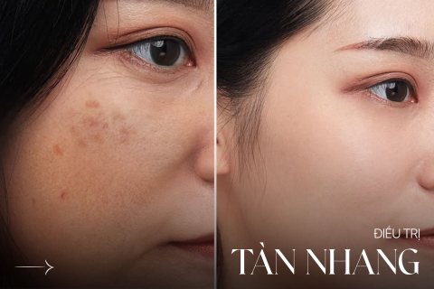 Điều trị tàn nhang